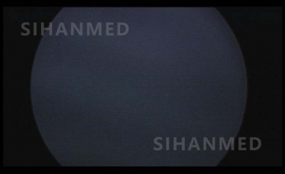 經皮腎鏡聯合輸尿管軟鏡同期治療介紹及SOPRO經皮腎鏡維修案例